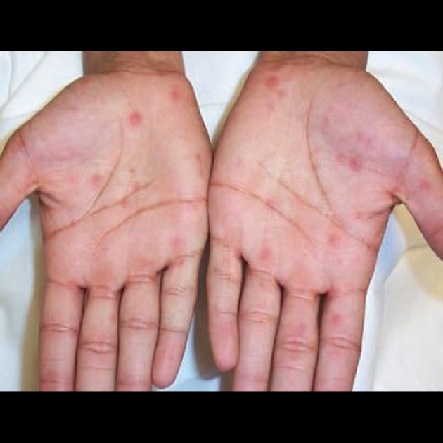 Secondary syphilis